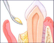 Bone Grafting