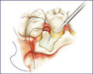 Bone Grafting