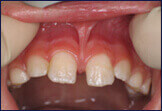 Frenectomy