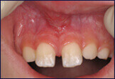 Frenectomy